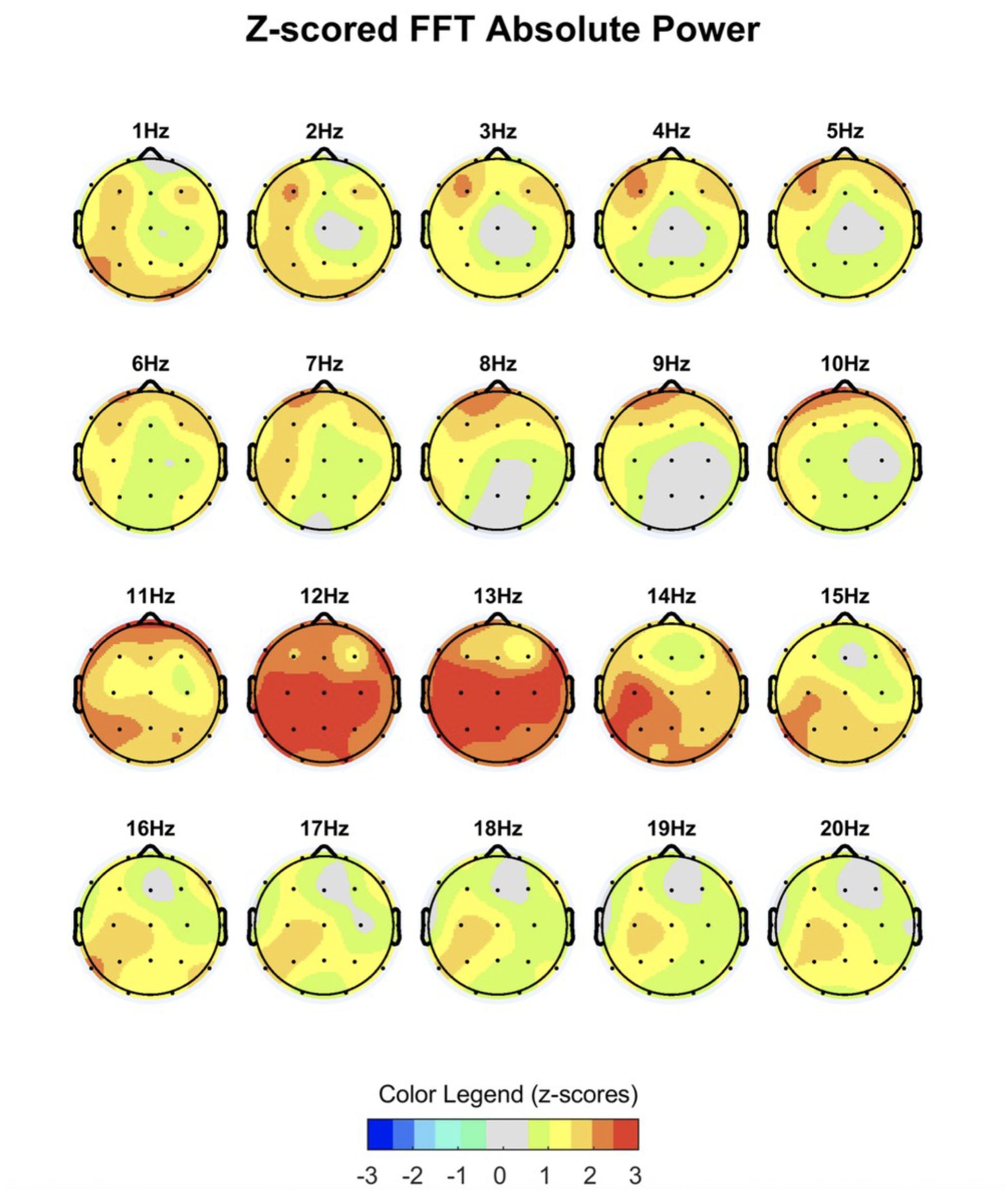 De-identified QEEG brain map titled “Z-scored FFT Absolute Power”: twenty head diagrams, one per frequency from 1 Hz to 20 Hz, coloured to show where activity sits above or below the age-matched norm, with a z-score colour legend below
